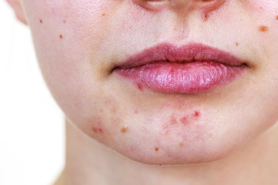 How To Tackle Acne and Oily Skin? A Guide to Remember! - Caraway